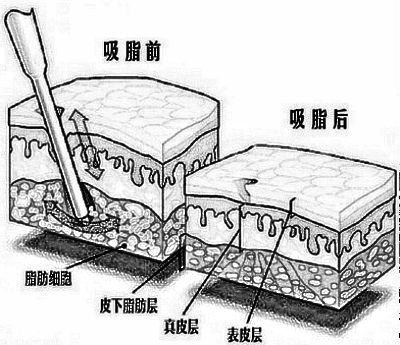 腿部吸脂术后护理小知识！