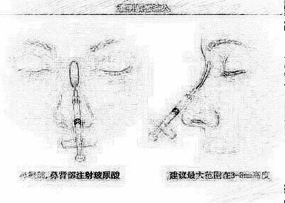 隆鼻局麻还是全麻好 没问题吗