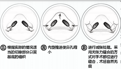 南通维多利亚做鼻翼缩小要多少钱 多久能恢复