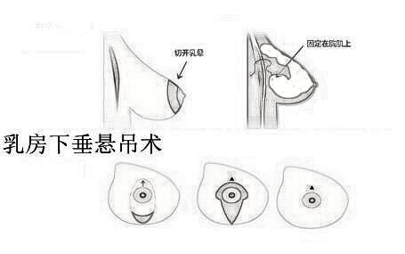 做乳房下垂矫正多少钱？