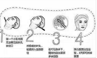 恩施做吸脂瘦脸手术大约要花多少钱?听说果还不错喃