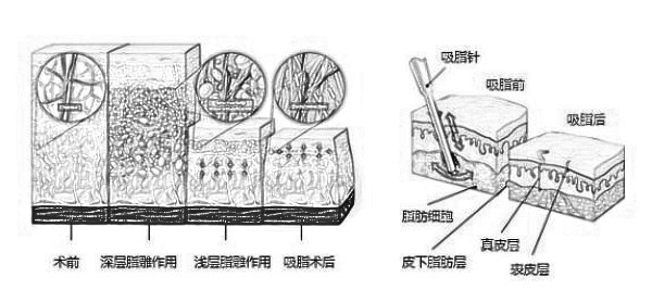 台州做360度吸脂大约花费多少钱喃？怎么收费比较合理？