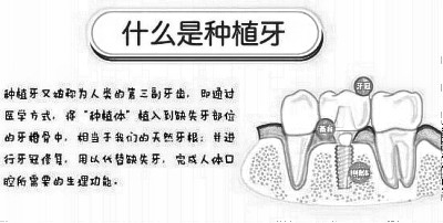 人工种植牙价格性价比高不高，什么因素影响了价格?