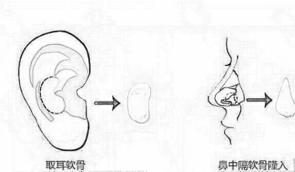 运城耳软骨隆鼻修复多少钱?听说收费还有点小贵呢?