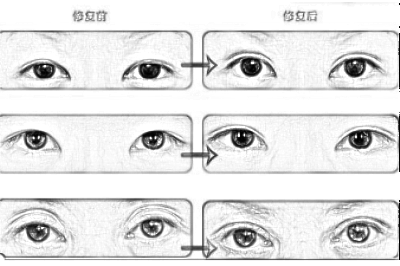 双眼皮修复的价格为什么很贵？比起价格更重要的是医生技术