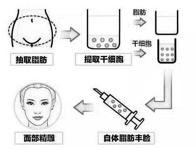 大同面部脂肪填充大概多少钱，市场价为什么不是统一的?