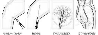 盐城吸脂瘦大腿大约多少钱，为什么会这么贵?