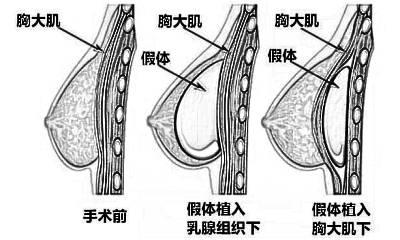 昆明奥诺拉假体丰胸价格高不高，收费区间?