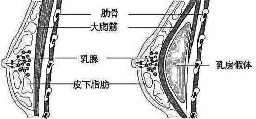 福州丰胸哪种方法好 假体丰胸手感果持久吗