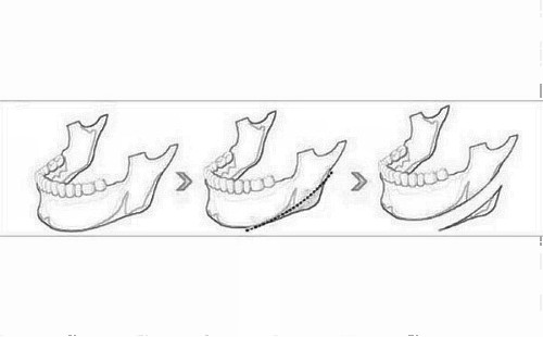 下颌角切除手术多少钱 这两个因素是关键