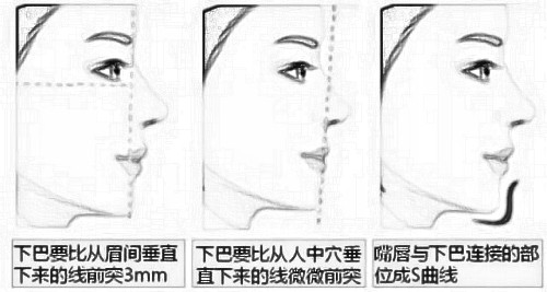 湛江医院假体垫下巴 让脸型更有亲和力