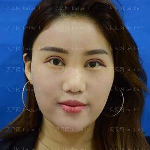 西京医院整形科彭湃切开双眼皮介绍片较新分享_眼睛恢复得毫无违和感了咯！