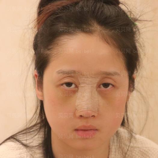 西京医院整形科宋保强鼻部手术介绍片较新分享_鼻子很立体，感觉气质都不一样咯哦！