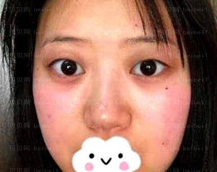 西京医院整形科宋保强假体隆鼻介绍片较新分享_同事们都认为我的鼻子做得很成功，不知道大家怎么看？