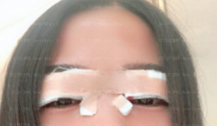 西京医院整形科易成刚眼部手术整形介绍片较新分享_保持好心态，恢复美眼睛！