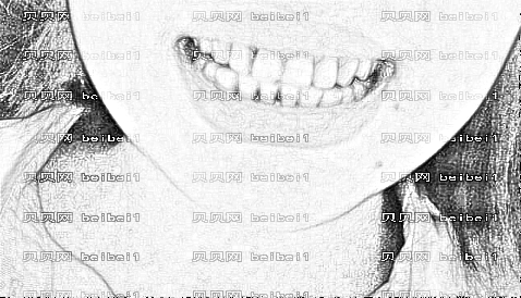 太原花妍年华医疗美容门诊部杨娜洁牙介绍片较新分享_术后牙齿不但没了结石，也白了很多啦！