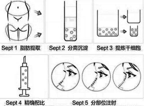 自体脂肪隆鼻的果怎么样？自体脂肪隆鼻可以维持多久？