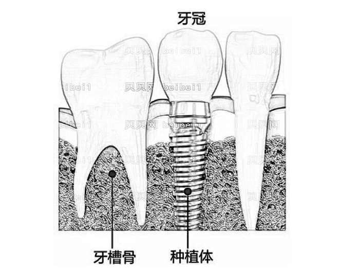 种植牙需要多长时间完成？种植牙齿有哪几个步骤？