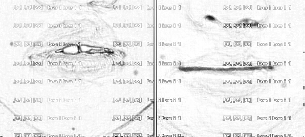 唇裂修复手术的较佳年龄是多少？全国唇裂修复较好的医院排名