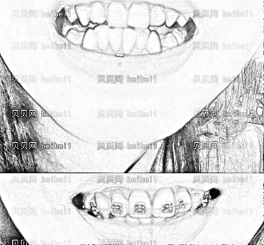 矫正牙齿是拔牙好还是不拔牙好？拔牙做牙齿矫正有后遗症吗？