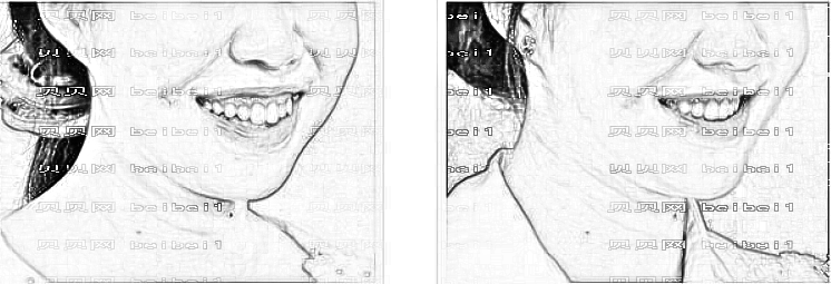 矫正牙齿为什么会出现牙套脸？牙套脸到底能不能恢复？