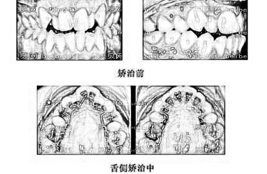 舌侧牙齿矫正会影响发音吗？舌侧牙齿矫正的优点和缺点有哪些？