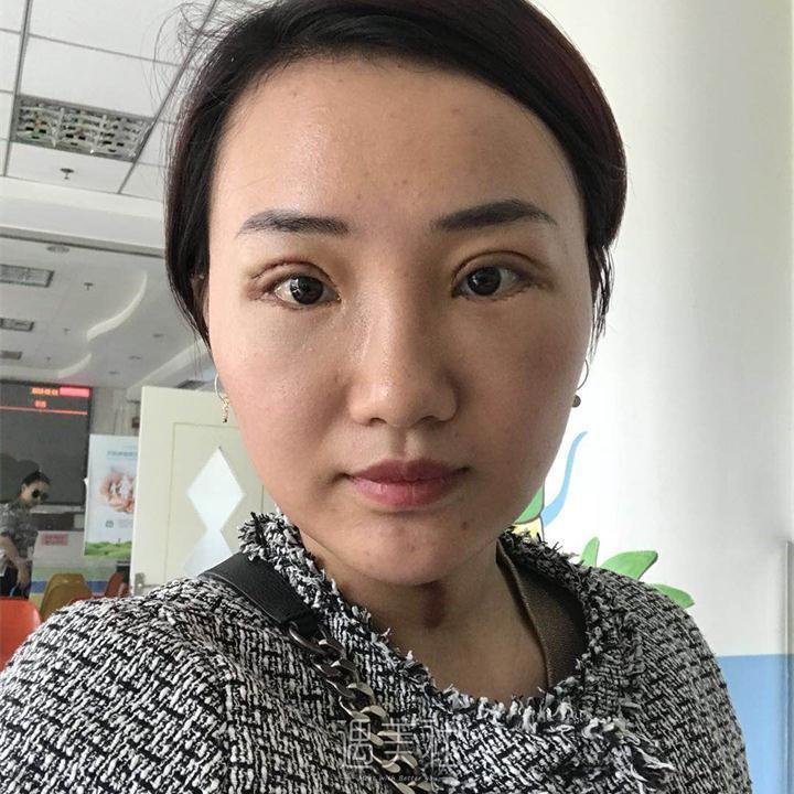 北京画美医疗美容医院——双眼皮