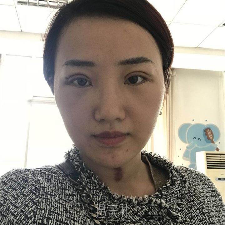 北京画美医疗美容医院——双眼皮