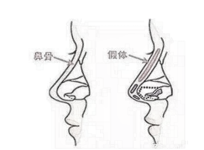 隆鼻硅胶和膨体有什么区别？如何选择？