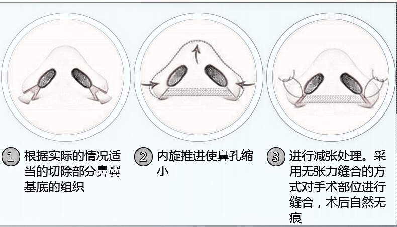 如何改变肥大的鼻子?