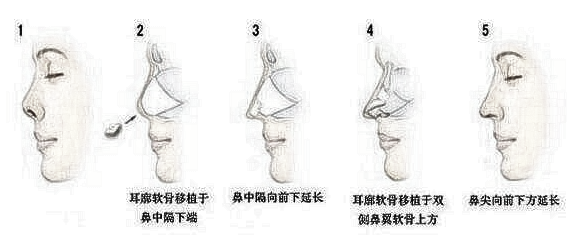 影响隆鼻果的几个原因你知道吗？