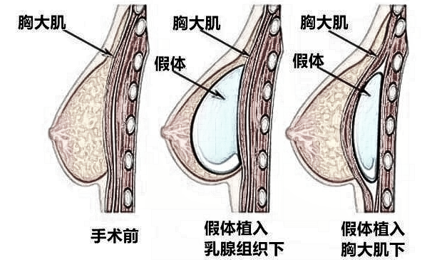 你知道你的隆胸植入物吗？有关假体隆胸乳房植入物的分类！