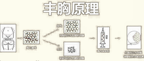 自体脂肪隆胸的方式及过程！