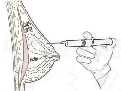 对于注射隆胸你怎么看？有什么优势吗？