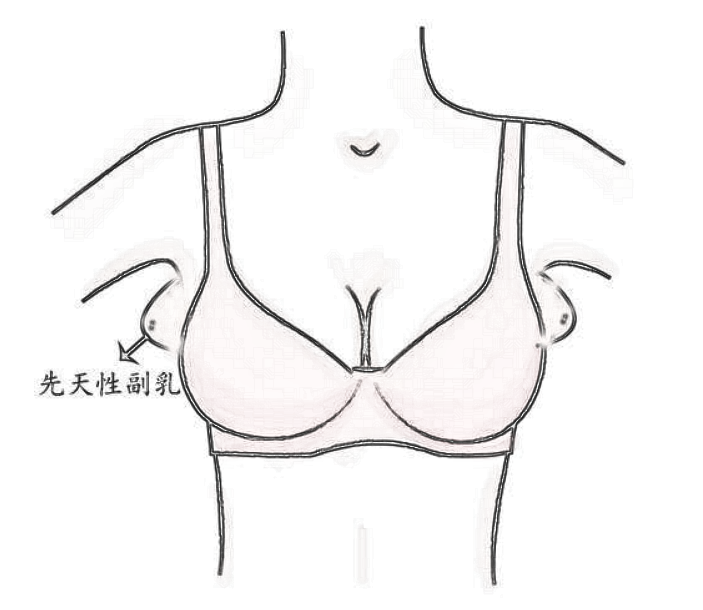 副乳分成这几类，你都知道吗？