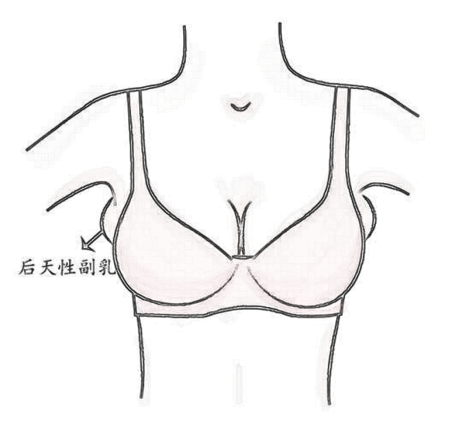 副乳分成这几类，你都知道吗？