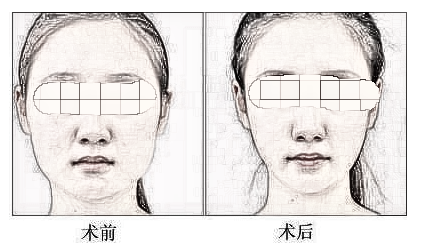 自吸填充全脸术前你应该了解的？