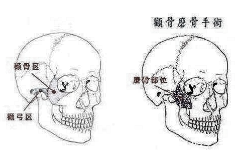 颧骨整形手术的恢复期是多久？恢复期需要注意什么？