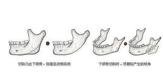 下颌角整形术前事项你知道吗？