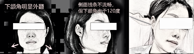 内行人怎么看待北京张笑天的下颌角手术？