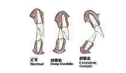 下巴短？可能跟深覆合有关