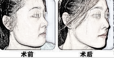 西京医院张曦磨骨怎么样 多少钱 后遗症