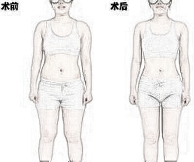 整形手术术前术后注意事项