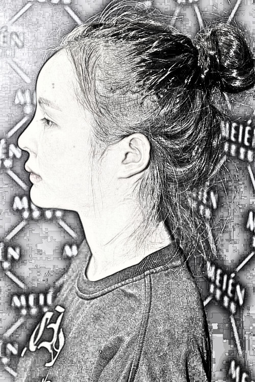 广东爱美者下颌角整形术后7周附分享！