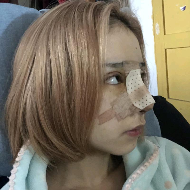 重庆新瑞俪医疗美容医生李光强隆鼻介绍分享!