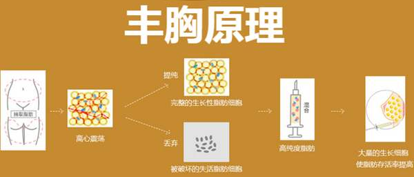 自体脂肪隆胸你真的了解吗？