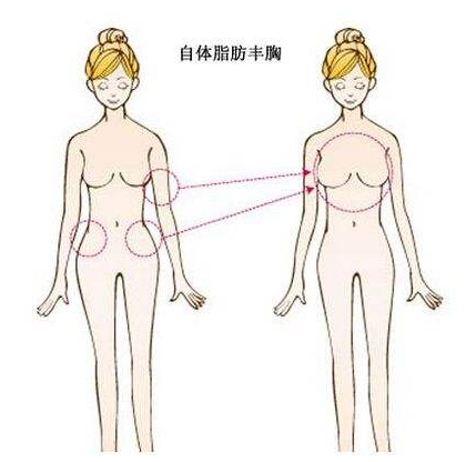 自体脂肪隆胸你真的了解吗？