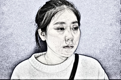 深圳小姐姐面部吸脂术后100天果分享附图