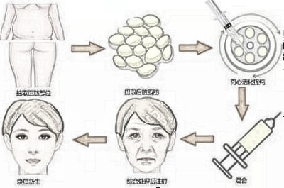 什么样的脸型和状态适合做自脂填充？