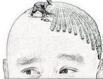 北京世熙整形医院植发科头发种植有哪些特点呢 有后遗症吗